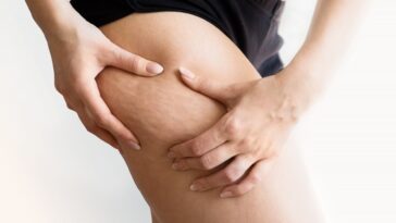 How to Get Rid of Cellulite Cellulite Causes Types Remedies