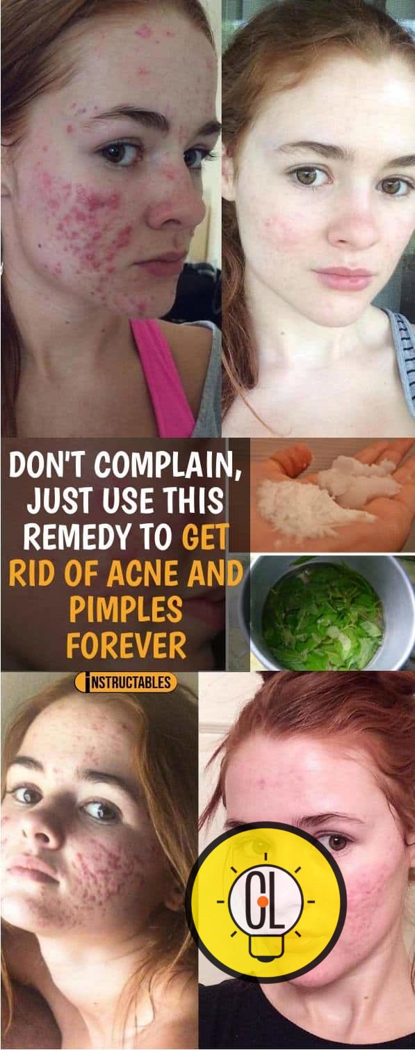 ACNE BUSTER