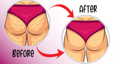 home remedies to get rid of cellulite 01