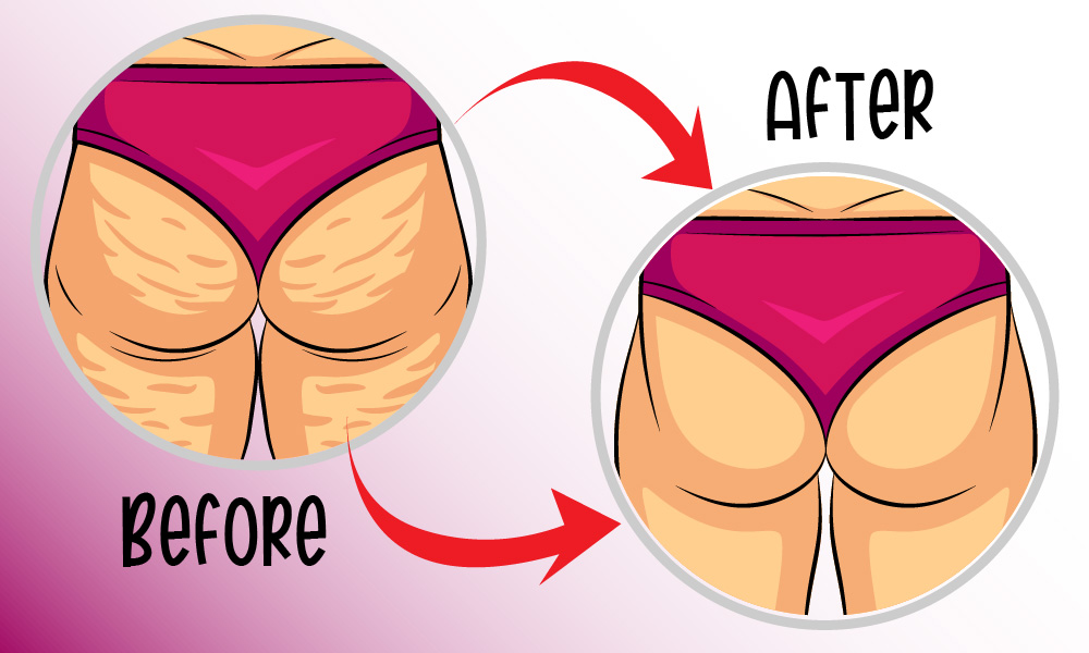 home remedies to get rid of cellulite-01