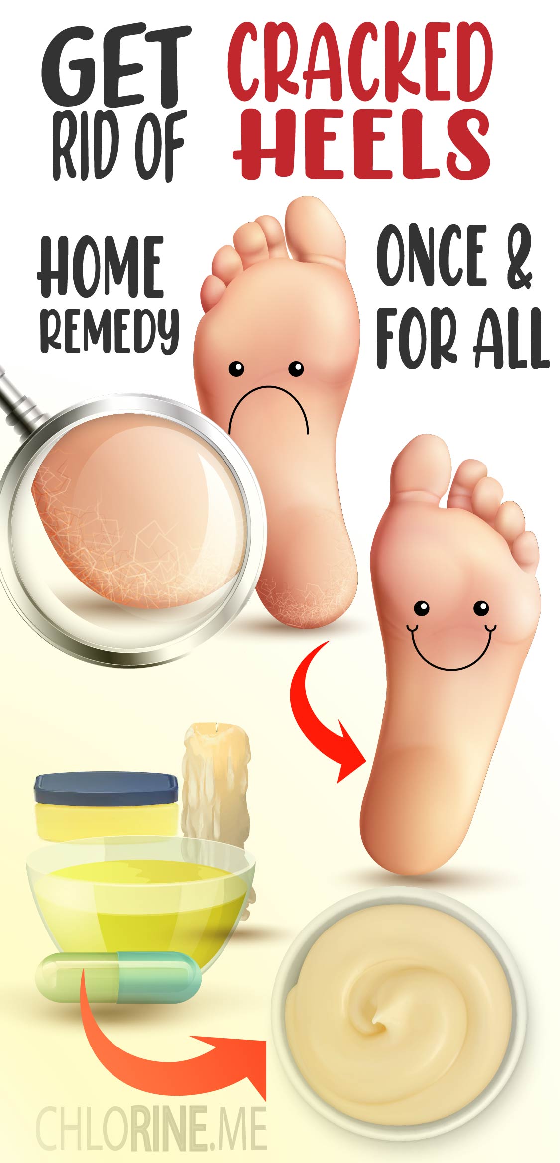 fix cracked heels home remedy