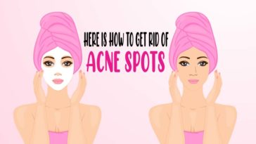 here is how to get rid of acne spots acne 01