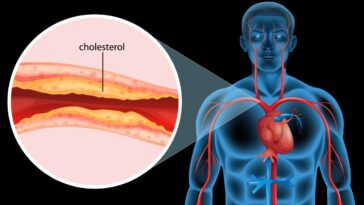 High Cholesterol 5 Great Drink Recipes for Vascular Health